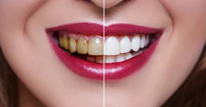 Diş Beyazlatma: Sağlık ve estetik için önemli adımlar